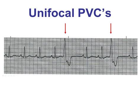 Unifocal Premature Ventricular Contractions | Images and Photos finder