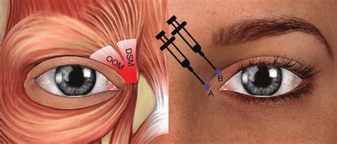 The mechanism and diagram of botulinum toxin type A treatment. (Left)... | Download Scientific ...