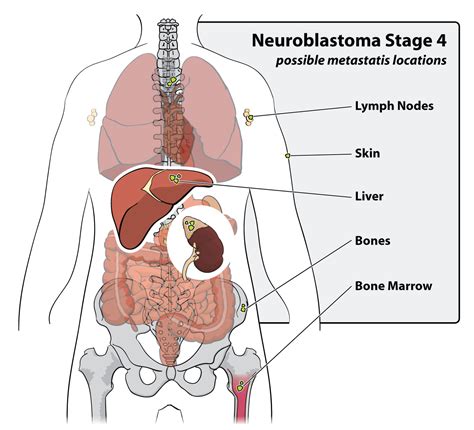 Neuroblastoma. Causes, symptoms, treatment Neuroblastoma