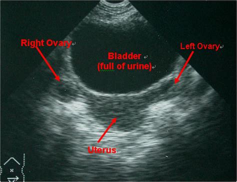 Female Pelvis – US – Toronto Notes