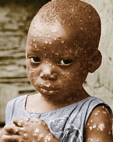 Posterazzi: Child With Smallpox Poster Print by Science Source (18 x 24) | Rakuten.com