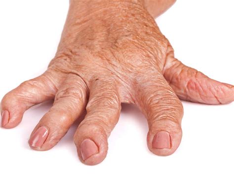 Rheumatoid arthritis pictures: Symptoms in the joints