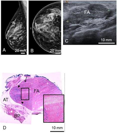 Complex Fibroadenoma Ultrasound