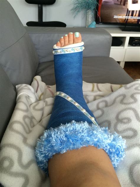 Sprained Ankle Full Leg Cast Clips Fractured Foot Clip | Hot Sex Picture