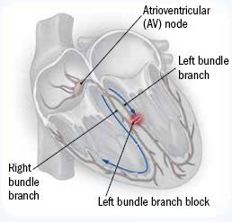 Bundle Branch Block Treatment Clinic