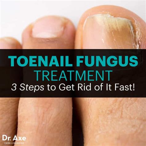 Toenail Fungus Treatment: 3 Steps to Get Rid of It Fast! - Dr. Axe