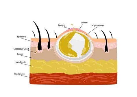 Abscess I & D – O360 Content Library