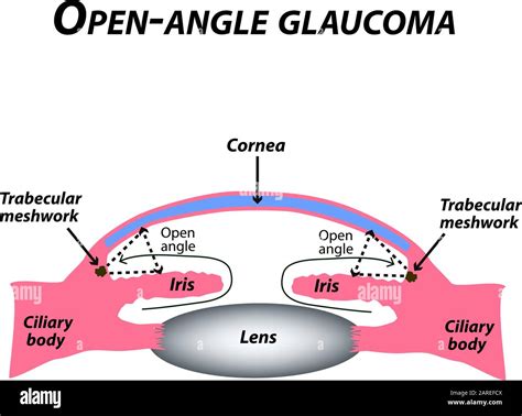 Open-angle glaucoma. A common type of glaucoma. The anatomical structure of the eye ...