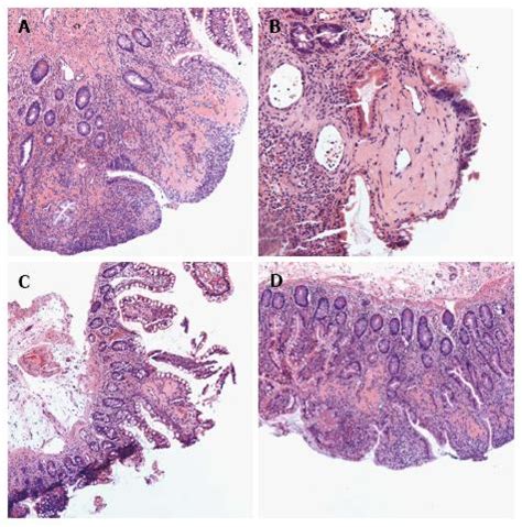 Portal Hypertension Histology