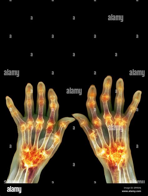 Rheumatoid Arthritis Hands X Ray