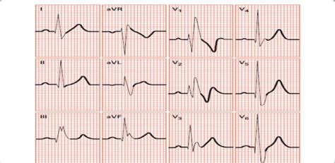 Morphology of RBBB arrhythmia: Figure shows various morphologies of... | Download Scientific Diagram