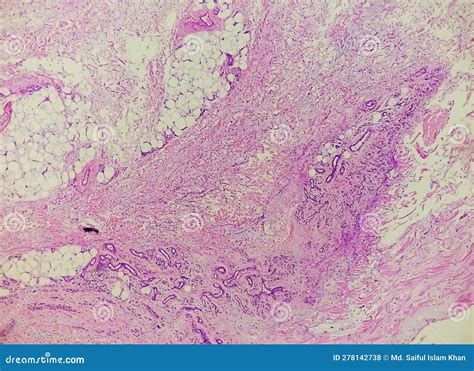 Prepatellar Region Histology Showing Bursitis, Acute or Chronic ...