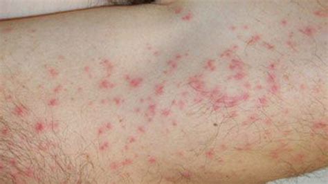 Cercarial Dermatitis: Symptoms, Treatment, and More