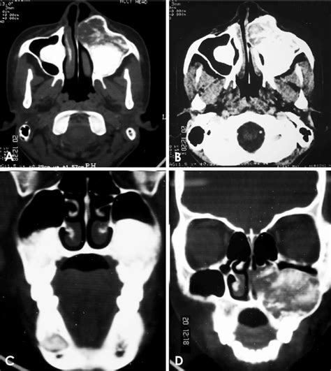 A and B. Axial computed tomographic (CT) images of the osteomeatal... | Download Scientific Diagram