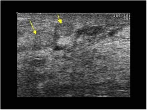 Breast and Axilla | 5.1 Benign lesions : Case 5.1.5 Galactoceles and sebaceous cysts ...