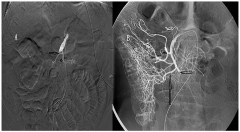 Biomedicines | Free Full-Text | Intra-Arterial Urokinase for Acute Superior Mesenteric Artery ...