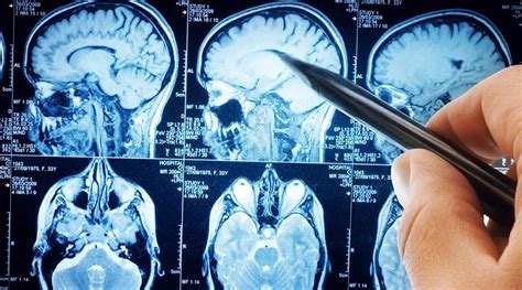 Physical & Chemical Impacts Of Depression On The Brain