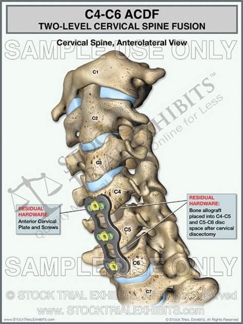 This trial exhibit shows the postoperative view of a two-level ACDF ...