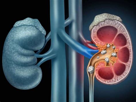 Kidney Stones: 10 Kidney Stones Symptoms