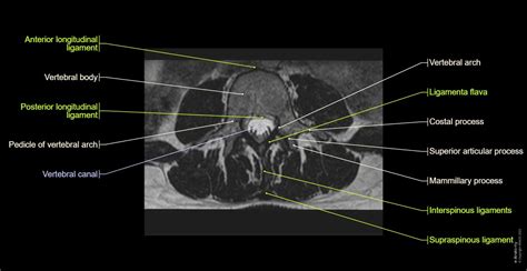 Anatomy of the lumbar vertebrae: normal anatomy | e-Anatomy