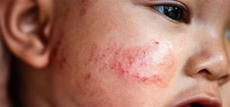 The Future Approach to Pediatric Atopic Dermatitis - MedScience