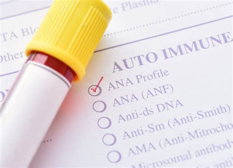 Antinuclear antibody (ANA) test diagnoses lupus erythematosus | Vinmec