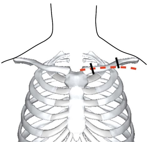 Thoracic Incisions - The Operative Review Of Surgery