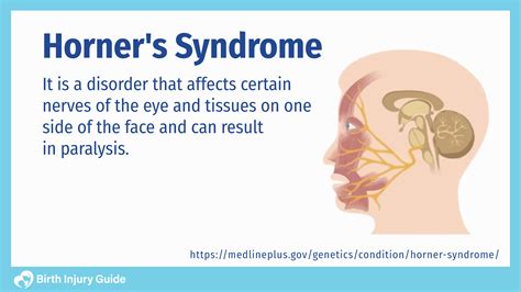 Horner's Syndrome, Causes, Symptoms and Treatment