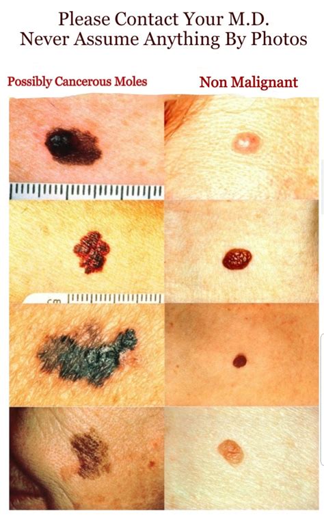 How to Check Your Moles for Skin Cancer (Melanoma)- See Pictures of Cancerous and Regular Moles ...