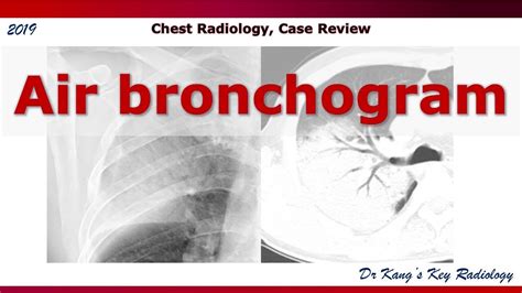 Air bronchogram, Chest radiographs and CT - YouTube