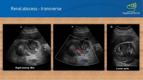 Renal abscess – NephroPOCUS