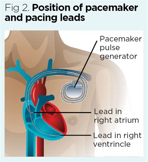 When your batteries are running low, turn down the lights. Permanent pacemakers and other ...