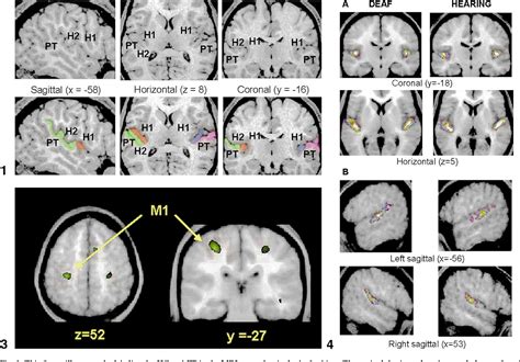 Figure 1 from The morphometry of auditory cortex in the congenitally deaf measured using MRI ...