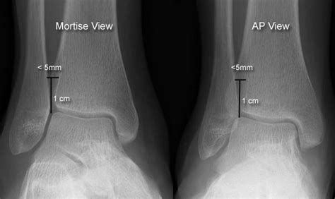 Ankle Syndesmosis Anatomy