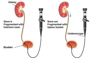 Effective RIRS Treatment for Urological Conditions