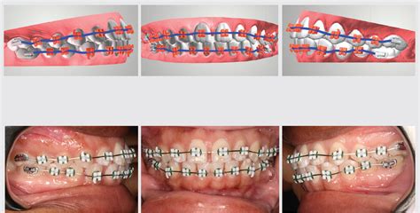 LightForce™ Braces - Northeast Orthodontics | St. Petersburg Seminole FL