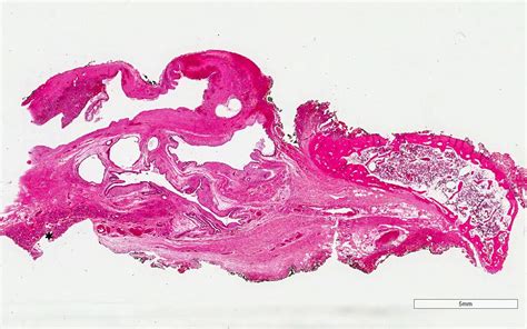 Thyroglossal Duct Cyst Histology