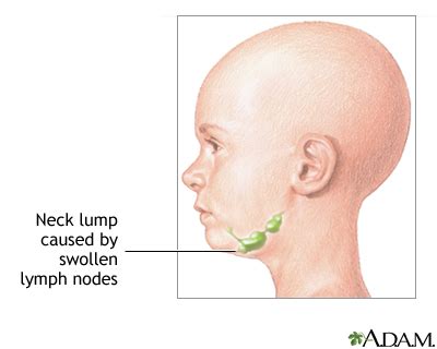 Neck lump | UF Health, University of Florida Health