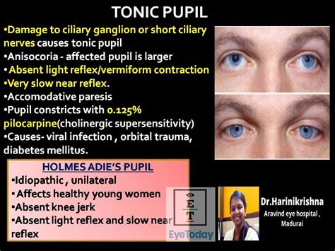 Tonic Pupil - EyeToday