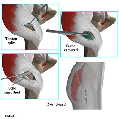 Trochanteric Bursitis Surgery | Houston Methodist