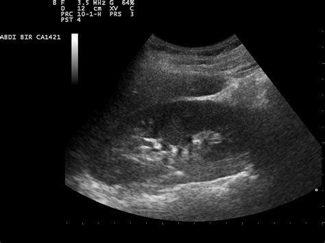 Ultrasound procedure for kidney stones | Urinary Tract Issues articles ...