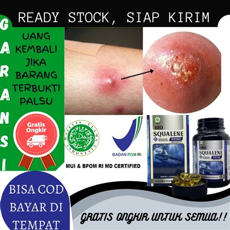 Jual Obat Penghilang Bisul, Lipoma, Benjolan Tiroid, Gondok / Gondongan ...