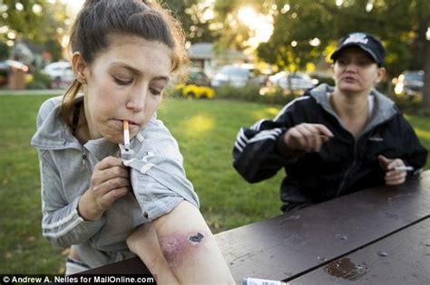 Krokodil Drug Before And After | www.pixshark.com - Images Galleries ...