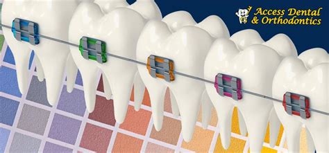 Braces Colors: How to Choose the Best Color for Your Smile - Access ...