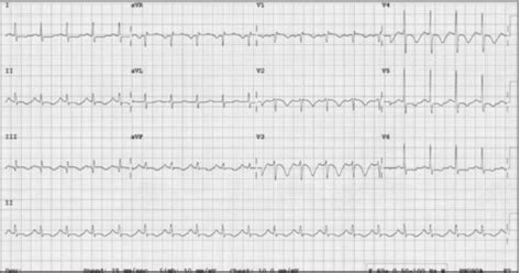 Pulmonary Embolism: Don't Throw Out That EKG! — NUEM Blog