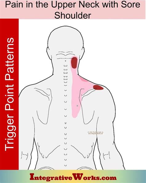 Upper Neck Pain with Sore Top of Shoulder - Integrative Works | Sore shoulder, Neck and shoulder ...