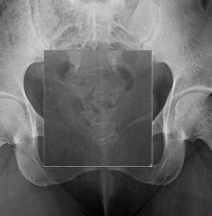 Coccyx X Ray Positioning - RoderickknoeJoyce