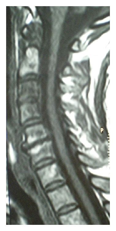 MRI sagittal view of the cervical spine showing a C5-C6 degenerative ...