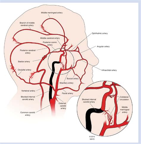 Figure 2 from Carotid artery disease: stenting vs endarterectomy ...