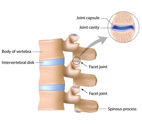 Facet Joint Syndrome | Pacific Sports & Spine